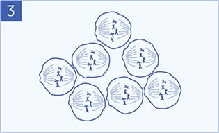 An illustration of several mesothelioma cells.