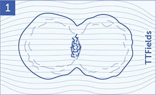 An illustration of mesothelioma cells being disrupted by TTFields.