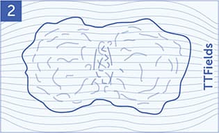 An illustration of mesothelioma cells being disrupted and warped by TTFields.