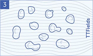 An illustration of the mesothelioma cells being destroyed.