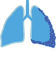 An illustration of a pair of light blue lungs with mesothelioma on the right lung. 