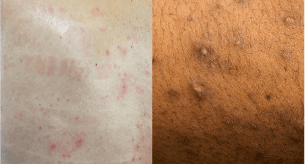 Side-by-side images of itchiness on dry and flaky lighter and darker skin.