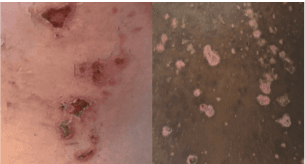 Side-by-side images of ulcers that look like scabs on darker and lighter skin.