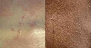 Side-by-side images of excessive sweating on lighter and darker skin.