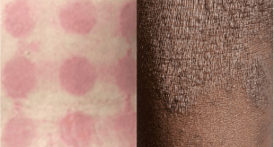 Side-by-side images of rashes on red and scaly lighter and darker skin.